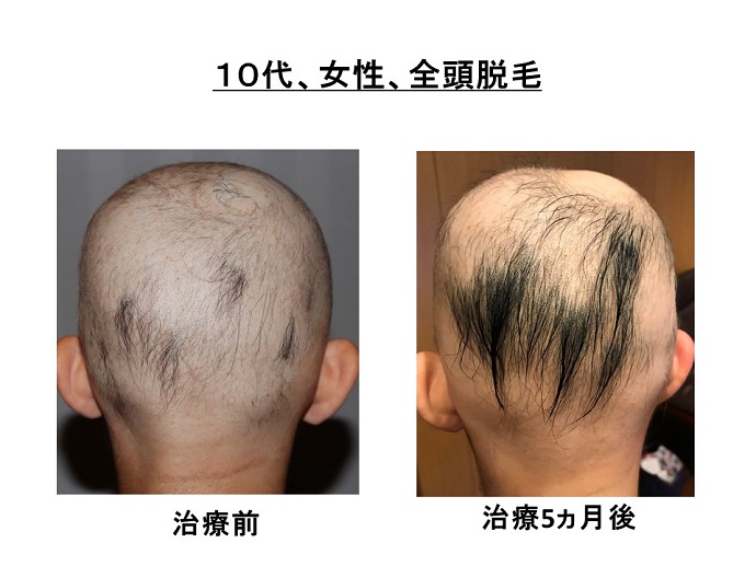 円形脱毛症　病院